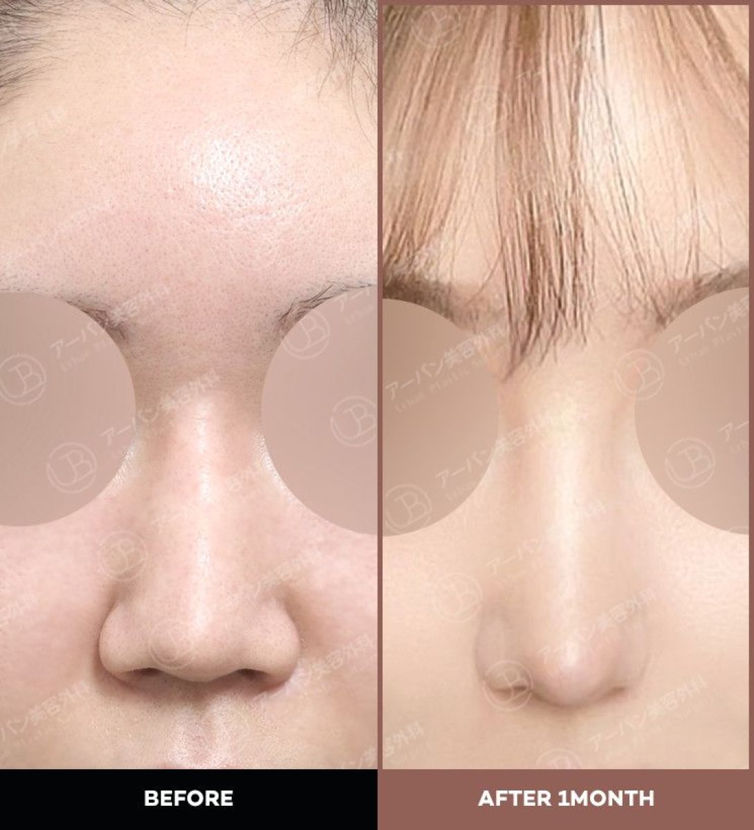 Resultados de alarplastia antes y después en URBAN Plastic Surgery, contorno nasal tras 1 mes