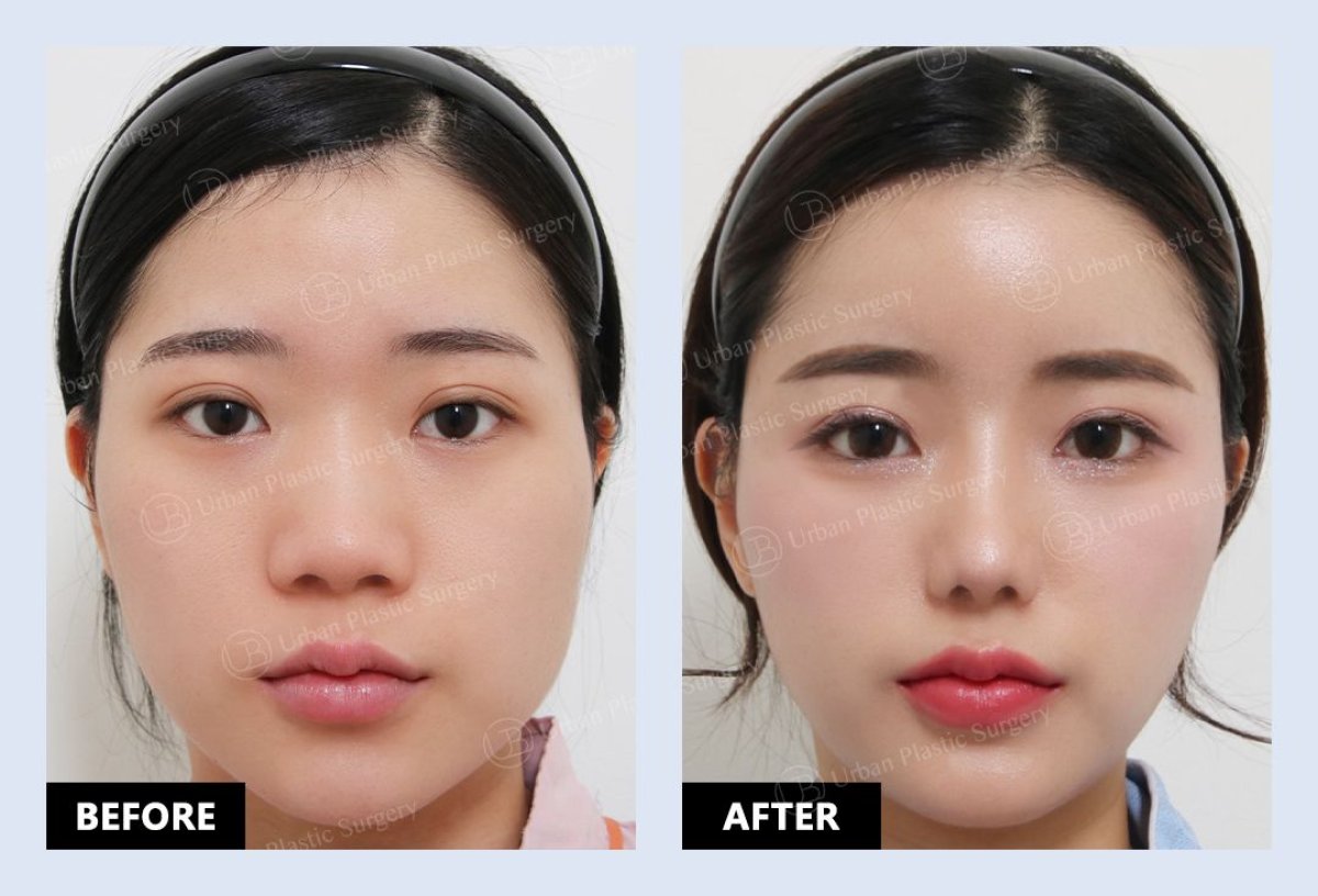 Resultados antes y después de alarplastia en URBAN Plastic Surgery, refinamiento nasal