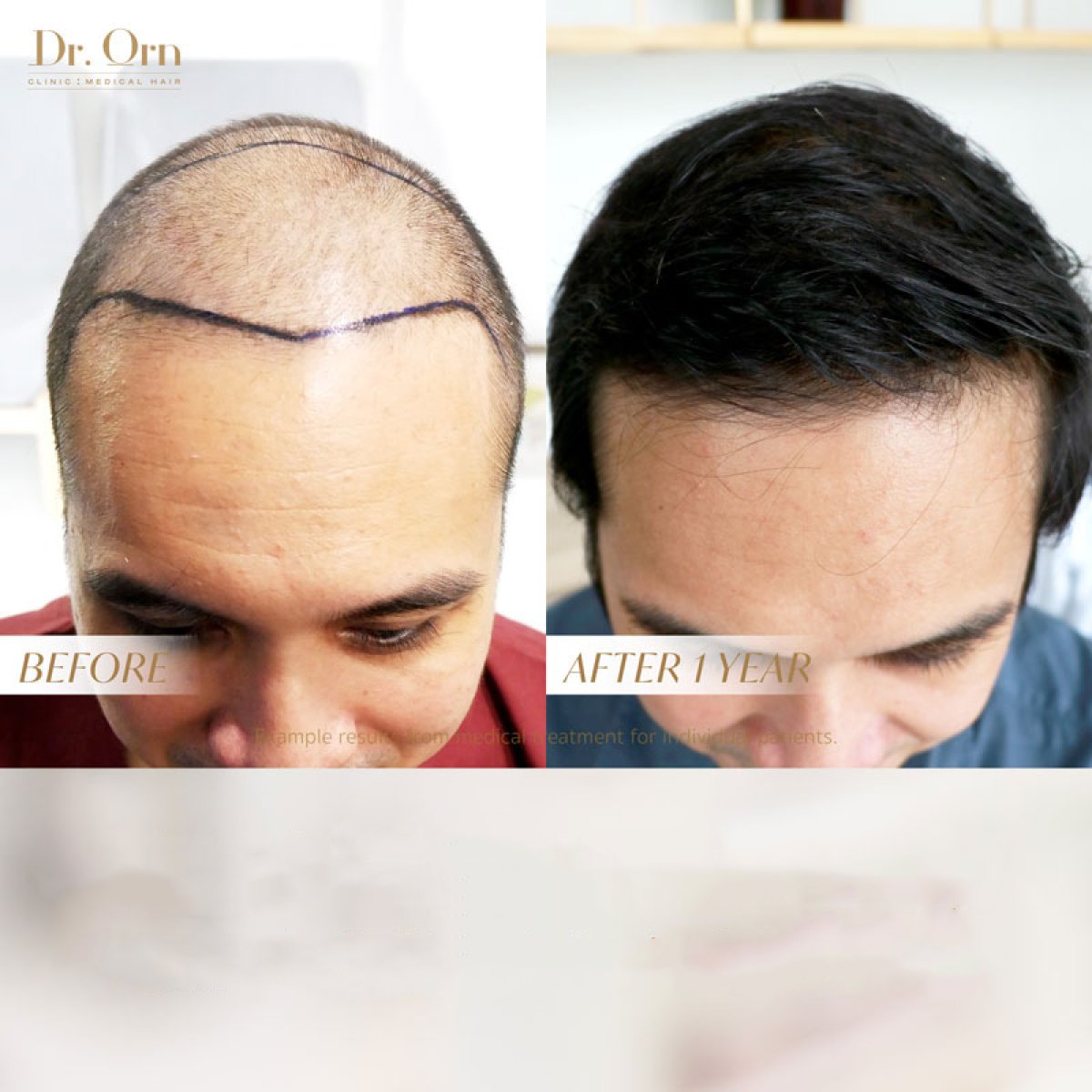 Before and after hair transplant results at Dr.Orn Clinic: fuller hairline after 1 year