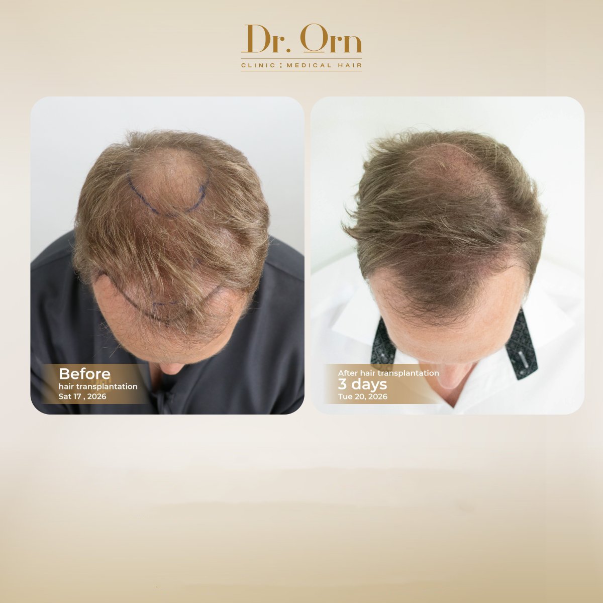 نتائج قبل وبعد زراعة الشعر في Dr.Orn Clinic : Medical Hair، كثافة شعر محسنة