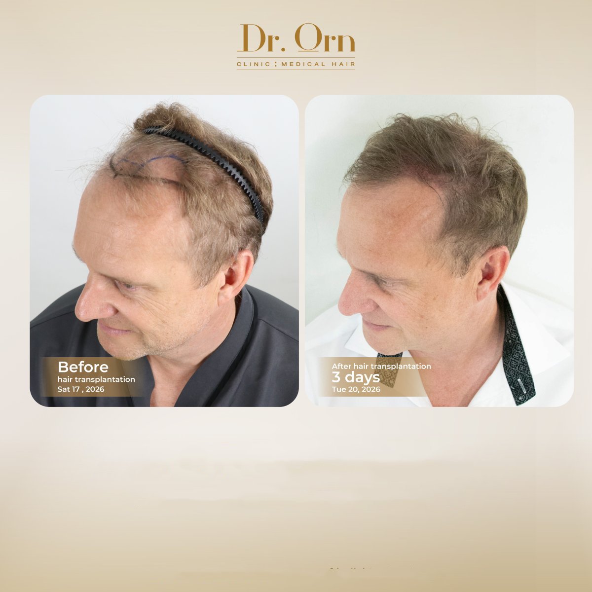 Before and after hair transplant results at Dr.Orn Clinic : Medical Hair, improved hairline