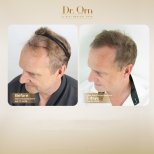 صور قبل وبعد زراعة الشعر للدكتور 