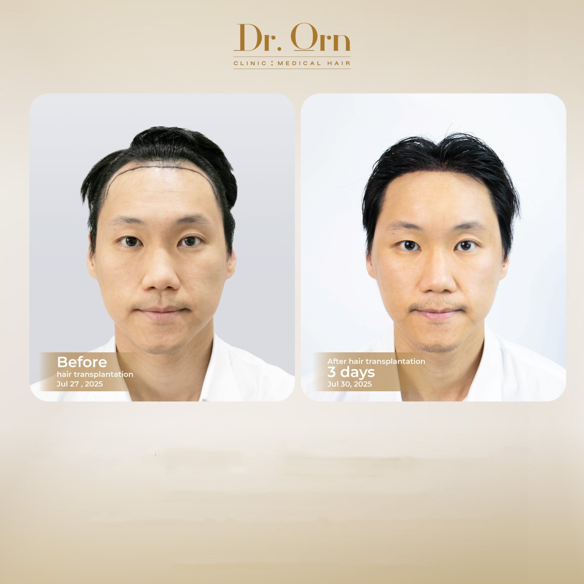 Before and after hair transplant results at Dr.Orn Clinic : Medical Hair, improved hairline