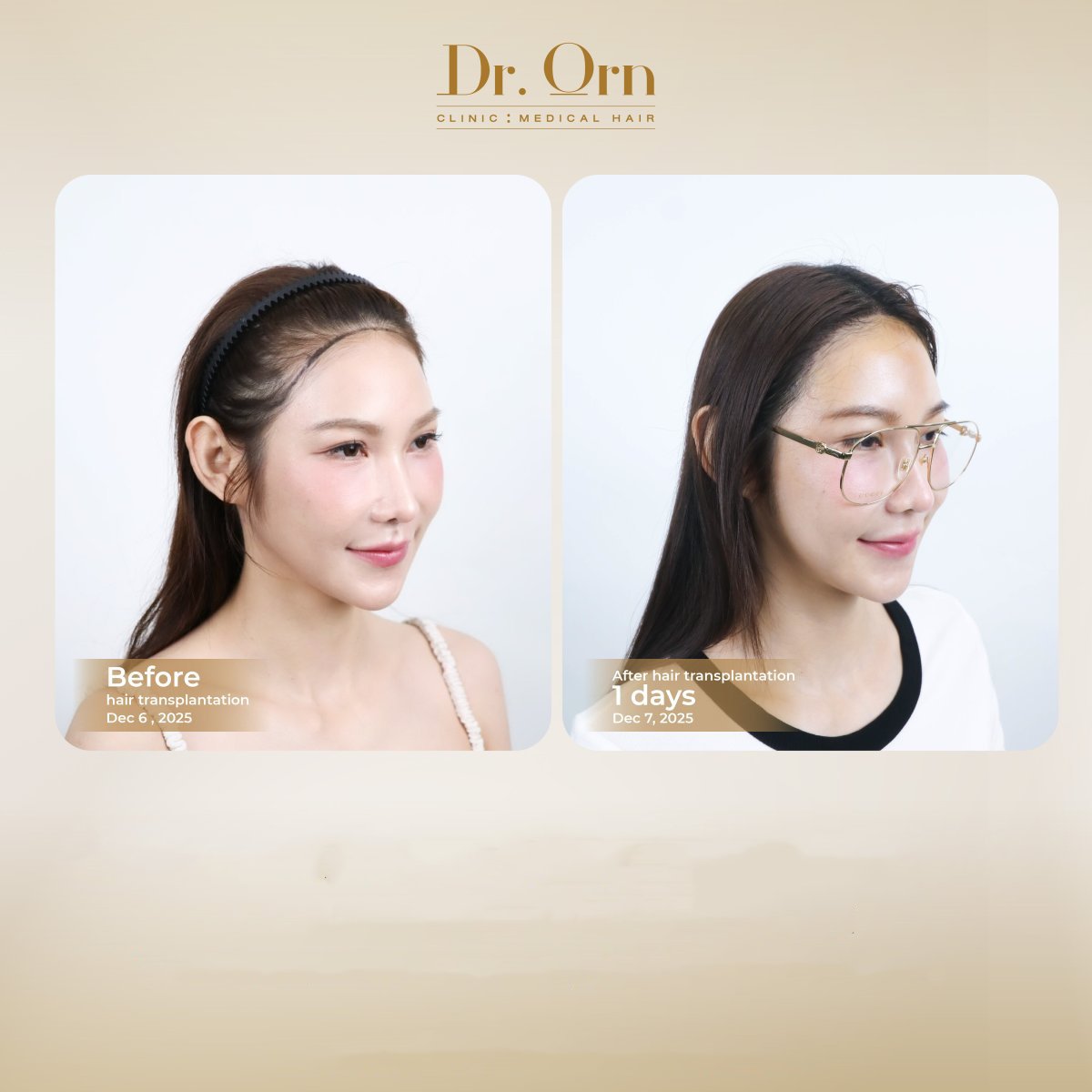 نتائج قبل وبعد زراعة الشعر في Dr.Orn Clinic : Medical Hair، خط شعر محسّن
