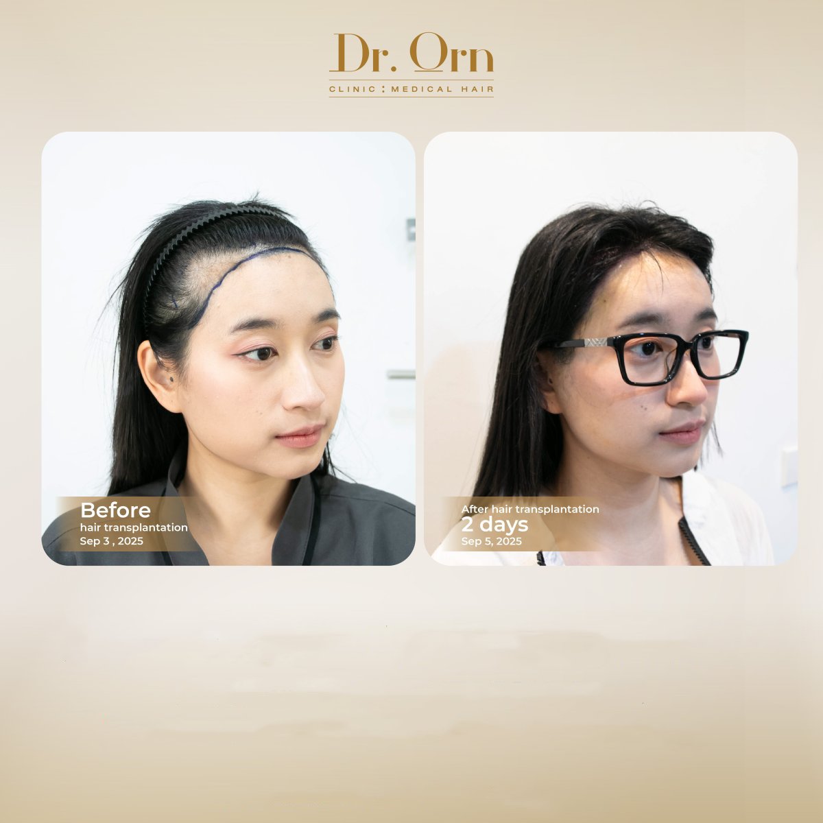 نتائج قبل وبعد زراعة الشعر في Dr.Orn Clinic : Medical Hair، خط شعر محسّن
