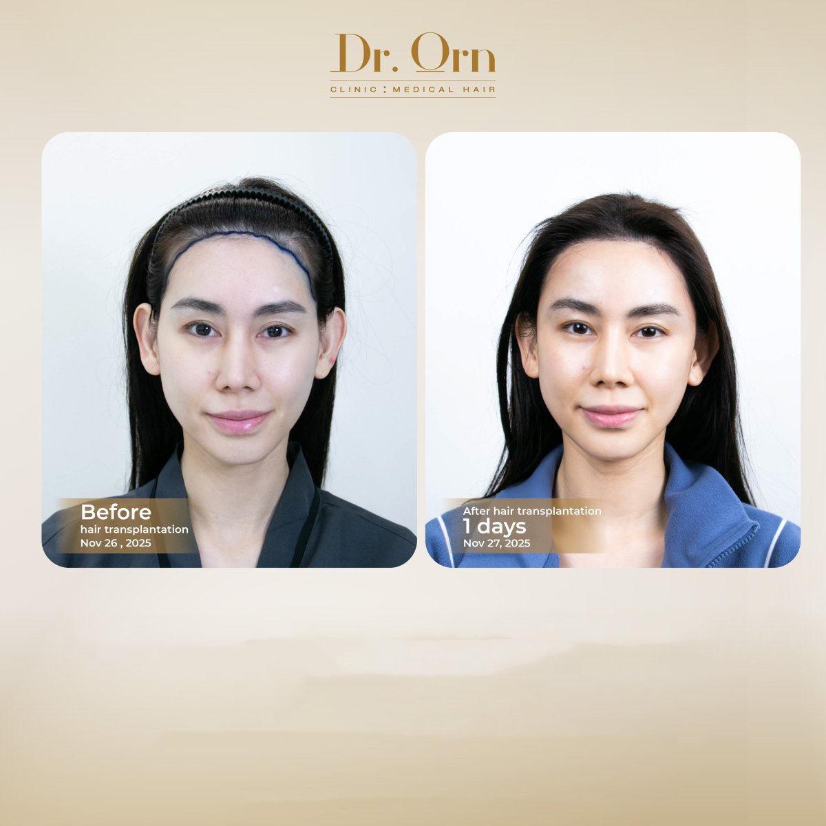 Результаты до и после пересадки волос в Dr.Orn Clinic : Medical Hair, улучшенная линия роста