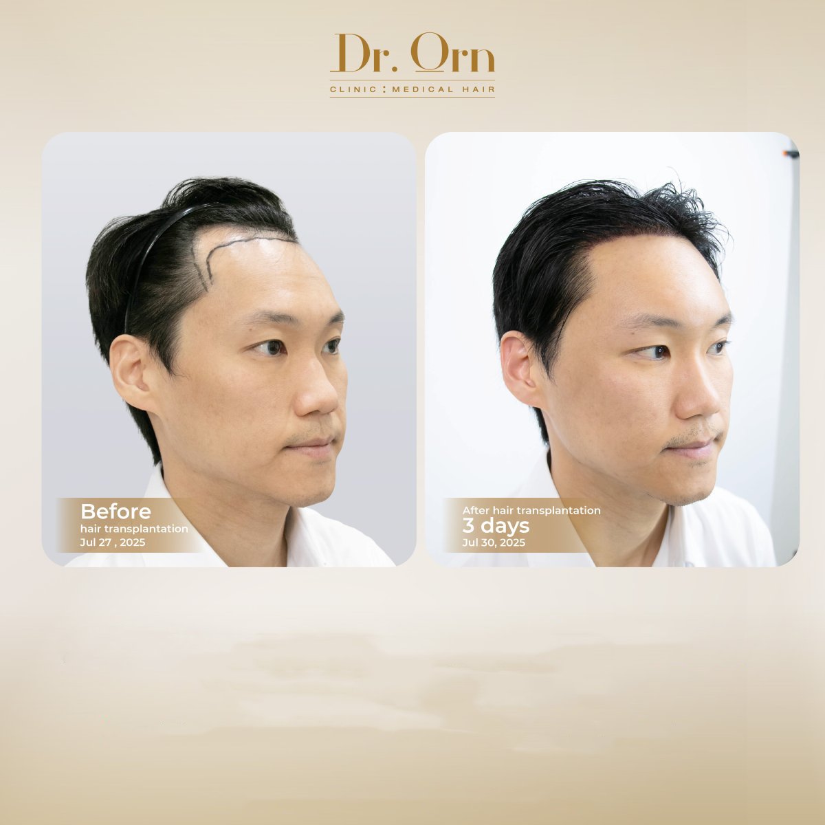 Efekty przed i po przeszczepie włosów w Dr.Orn Clinic : Medical Hair, poprawiona linia