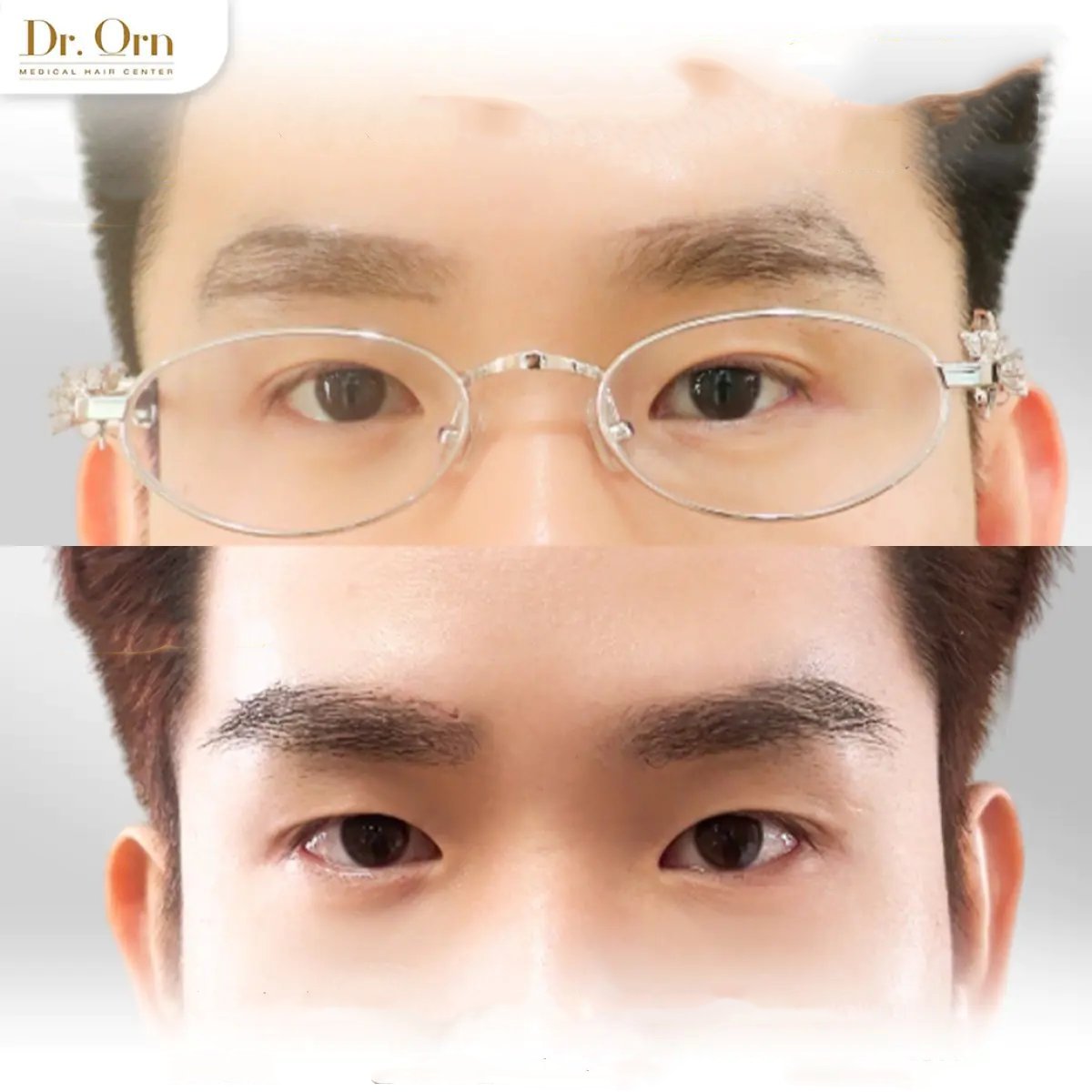 نتائج زراعة الحواجب قبل وبعد في Dr.Orn Clinic : Medical Hair، حواجب أكثر كثافة