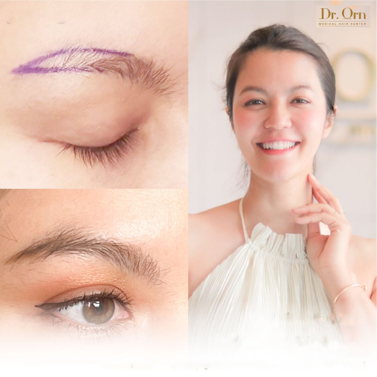 Résultats avant/après greffe de sourcils à Dr.Orn Clinic : Medical Hair, sourcils plus fournis