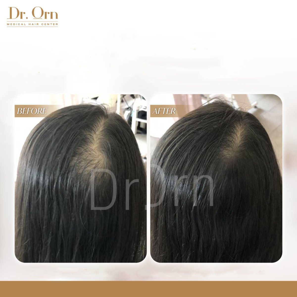 نتائج زراعة الشعر قبل وبعد في Dr.Orn Clinic: كثافة شعر محسّنة للنساء