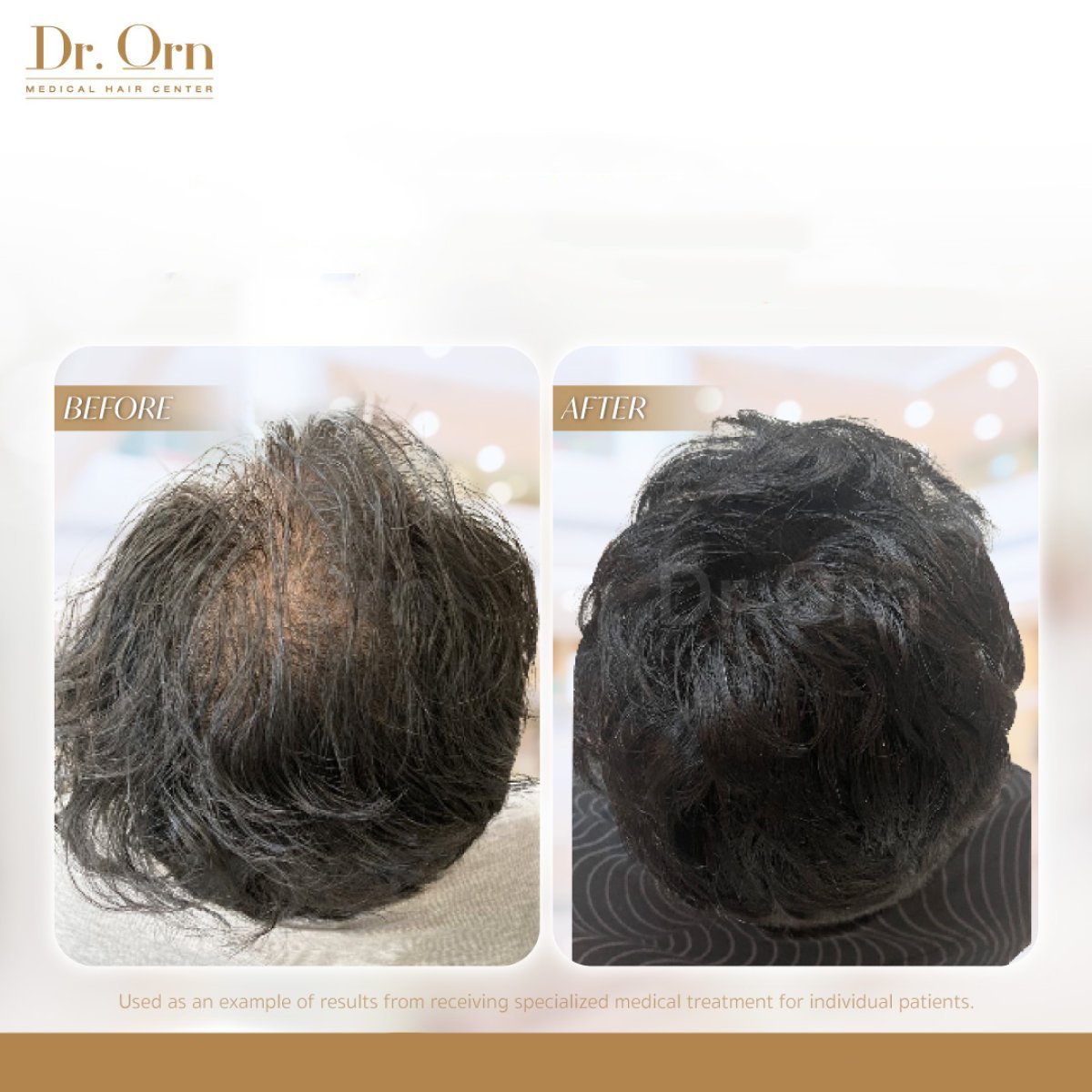 نتائج زراعة الشعر قبل وبعد في Dr.Orn Clinic: كثافة شعر محسنة على فروة الرأس