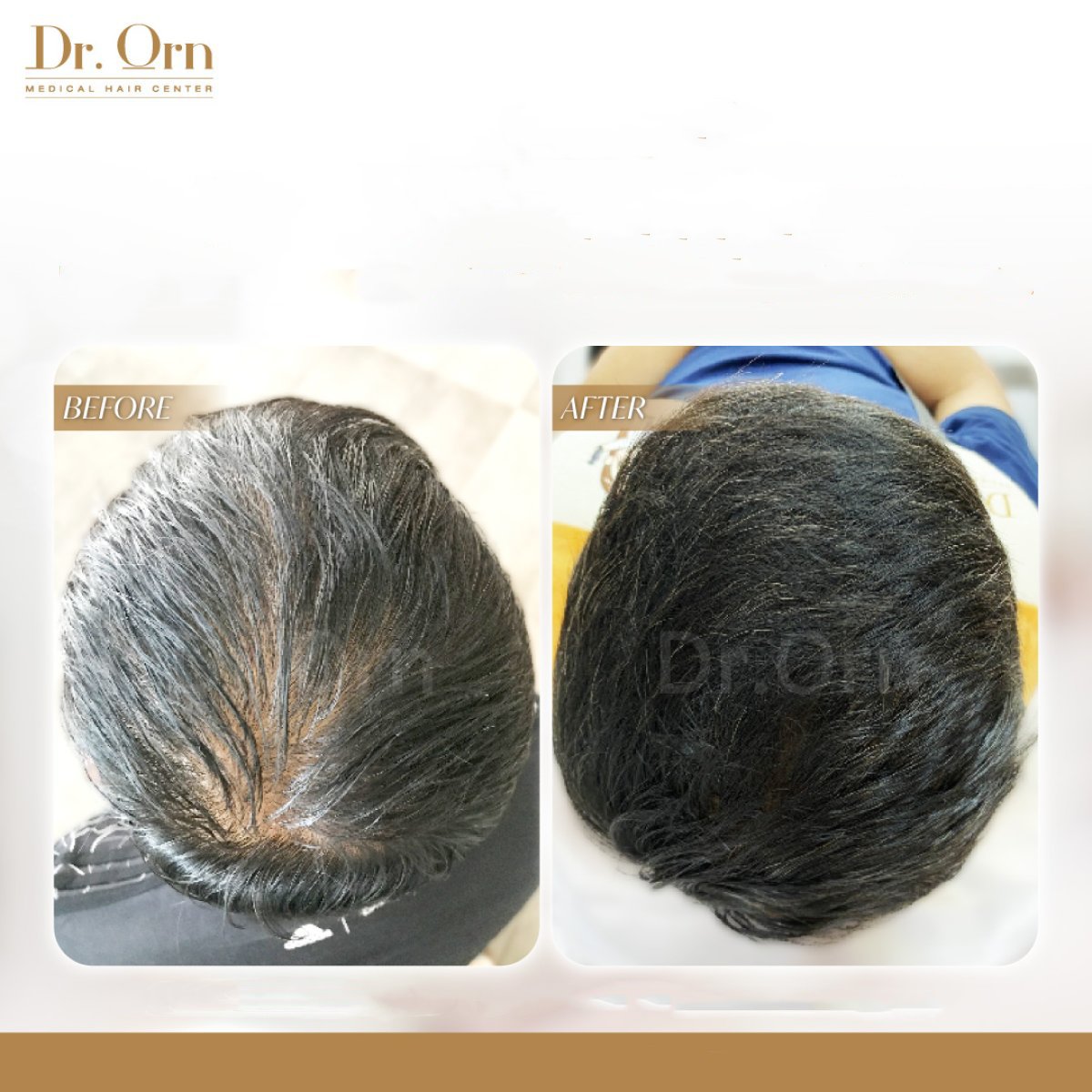 Результати до та після пересадки волосся в Dr.Orn Clinic : Medical Hair, густота волосся