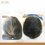 صور قبل وبعد زراعة الشعر للدكتور 