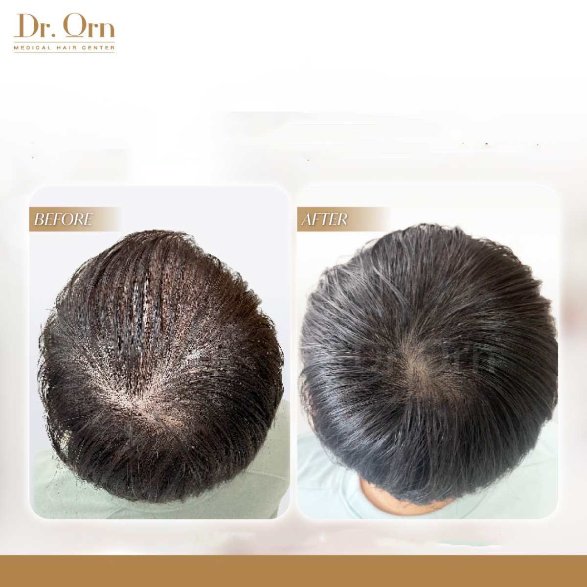 نتائج زراعة الشعر قبل وبعد في Dr.Orn Clinic: كثافة شعر محسنة في منطقة التاج