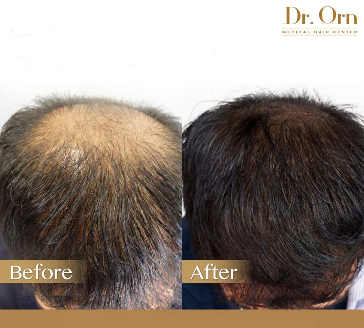 Before and after hair transplant result at Dr.Orn Clinic : Medical Hair, restored hair density