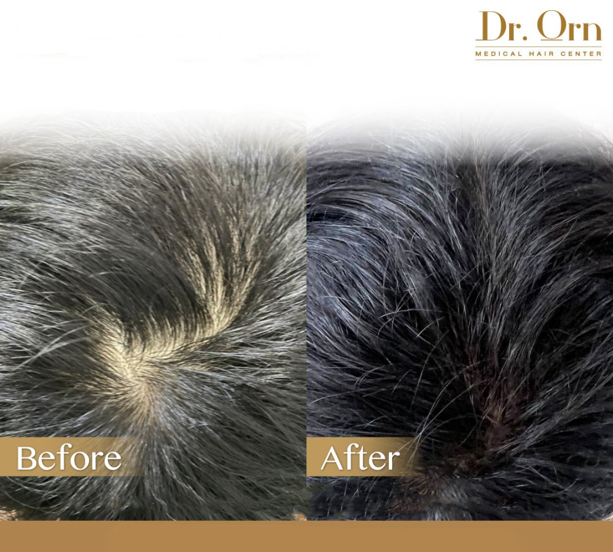 Resultados de trasplante capilar antes y después en Dr.Orn Clinic : Medical Hair, mayor densidad