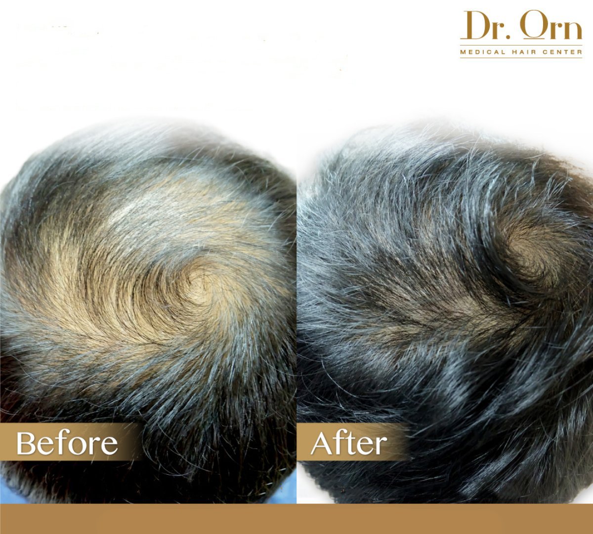 نتائج زراعة الشعر قبل وبعد في Dr.Orn Clinic: كثافة شعر محسنة في التاج