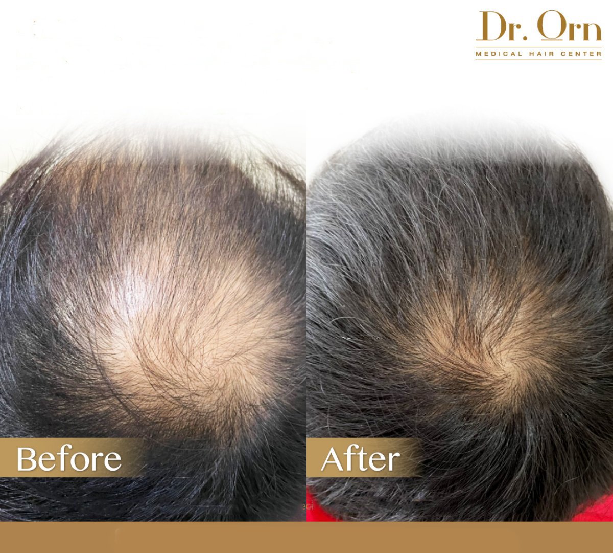 نتائج زراعة الشعر قبل وبعد في Dr.Orn Clinic: كثافة شعر محسنة في منطقة التاج