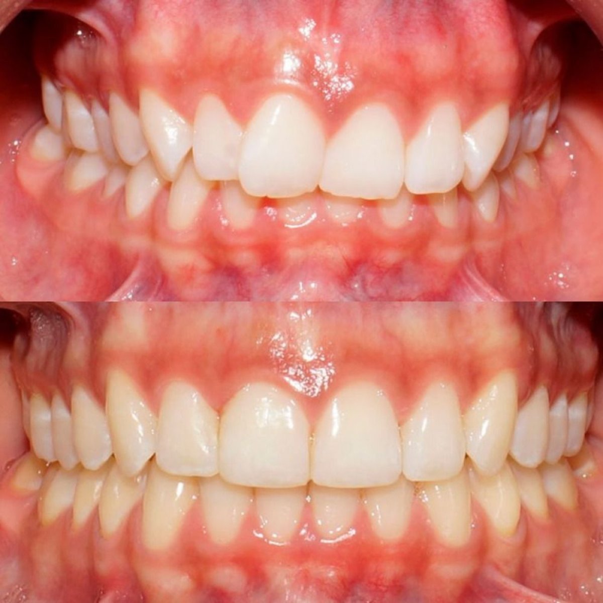 Before and after dental veneers at Ortodoncia CDMX, improved smile alignment and aesthetics