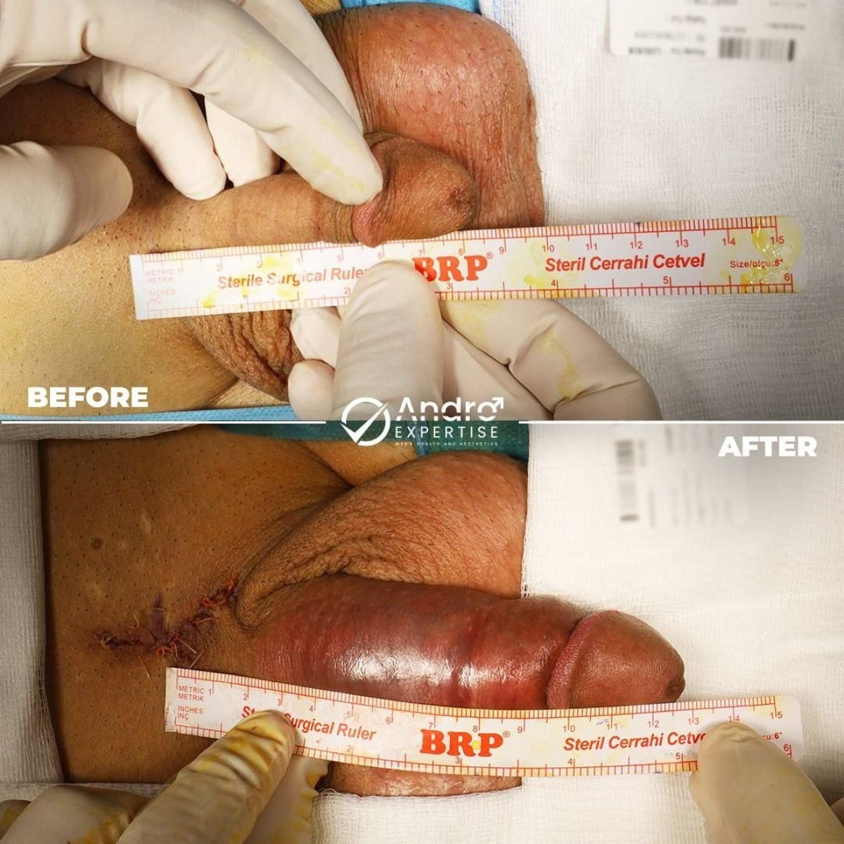 Результаты до и после фаллопротезирования в Andro Expertise Men's Health and Aesthetics