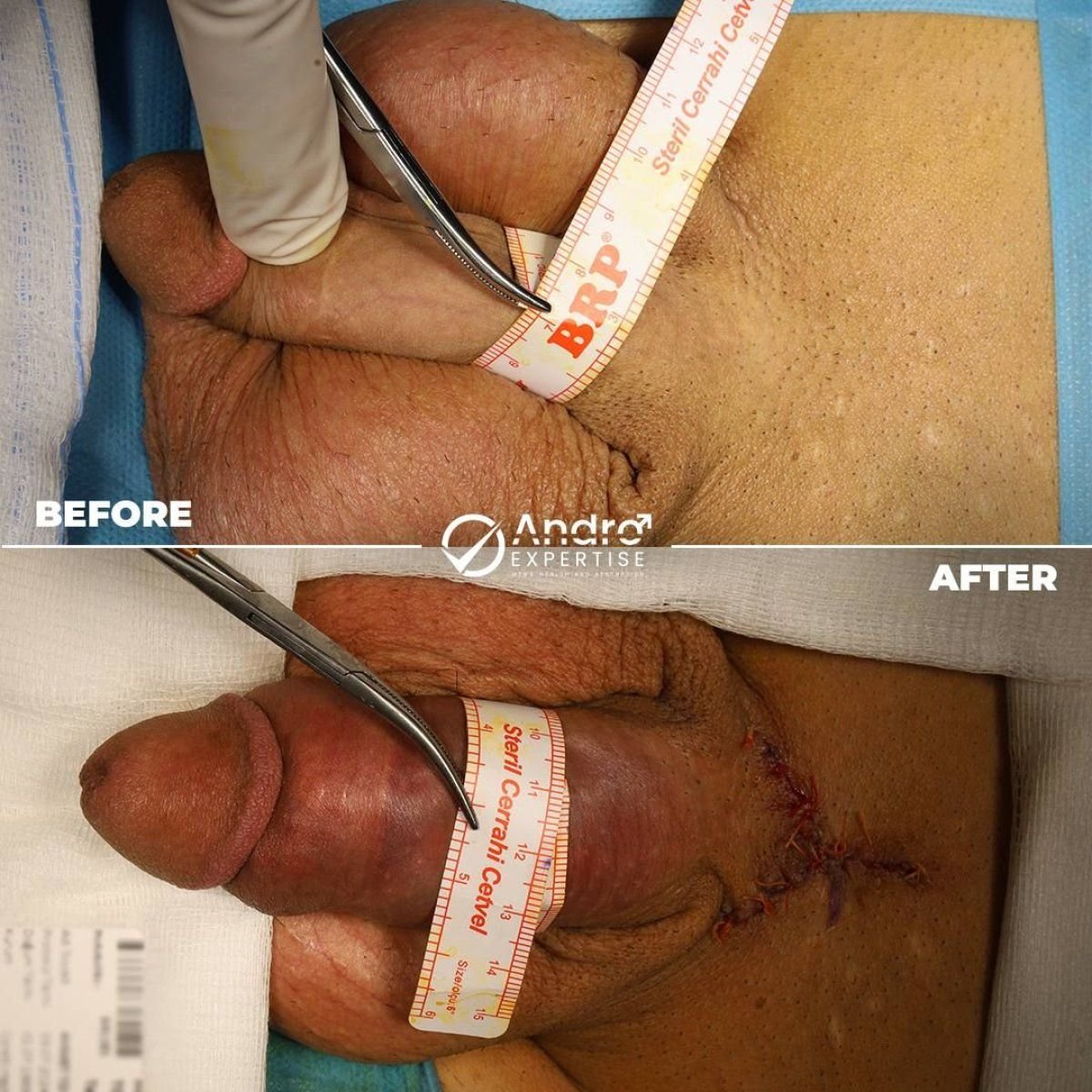 Результаты до и после фаллопротезирования в Andro Expertise Men's Health and Aesthetics