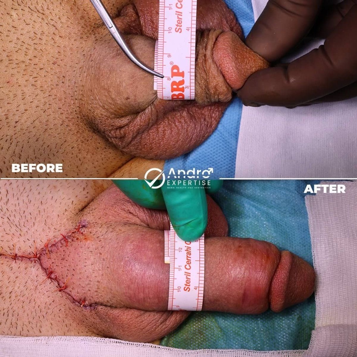 Результати до і після фалопротезування в Andro Expertise Men's Health and Aesthetics
