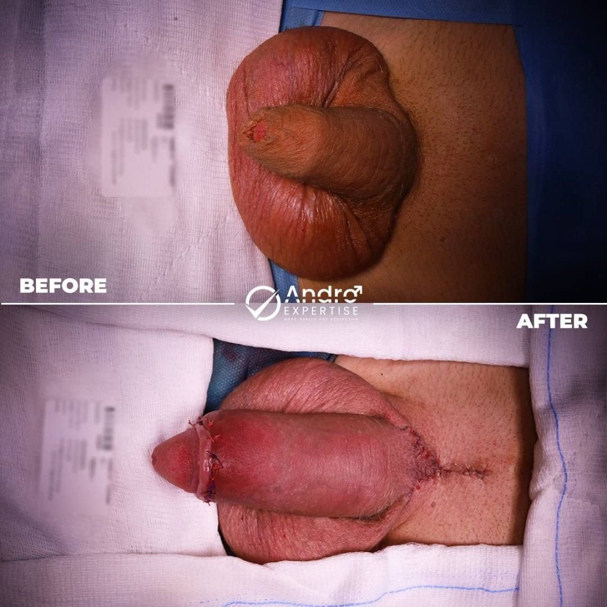 Before and after penile implant surgery results at Andro Expertise Men's Health and Aesthetics
