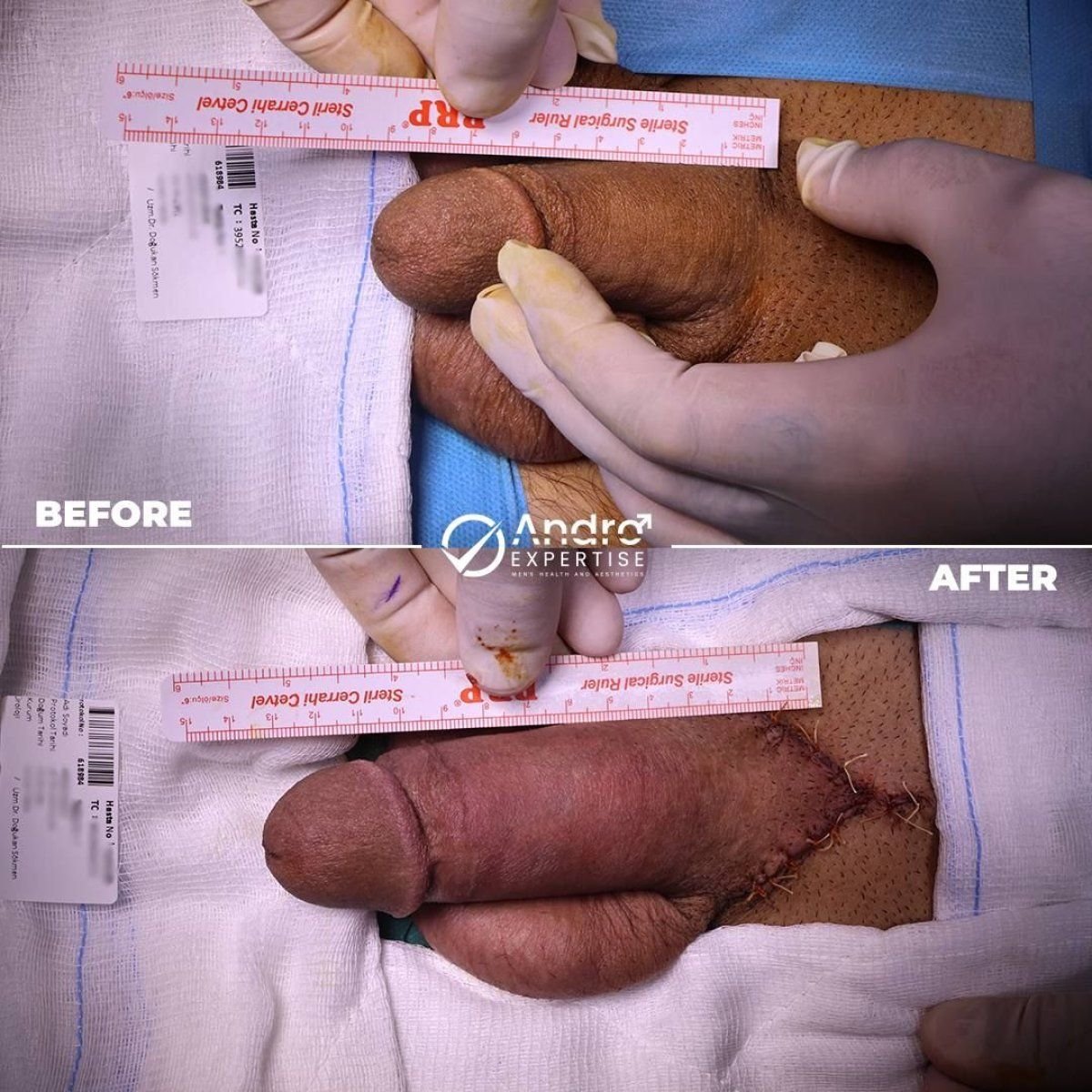 Résultats avant et après implant pénien chez Andro Expertise Men's Health and Aesthetics