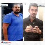 Roux-en-Y Gastric Bypass results by Dr. - Patient’s before and after images Before and after Roux-en-Y Gastric Bypass photos by Dr.