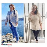 Before and after Roux-en-Y Gastric Bypass photos by Dr. 