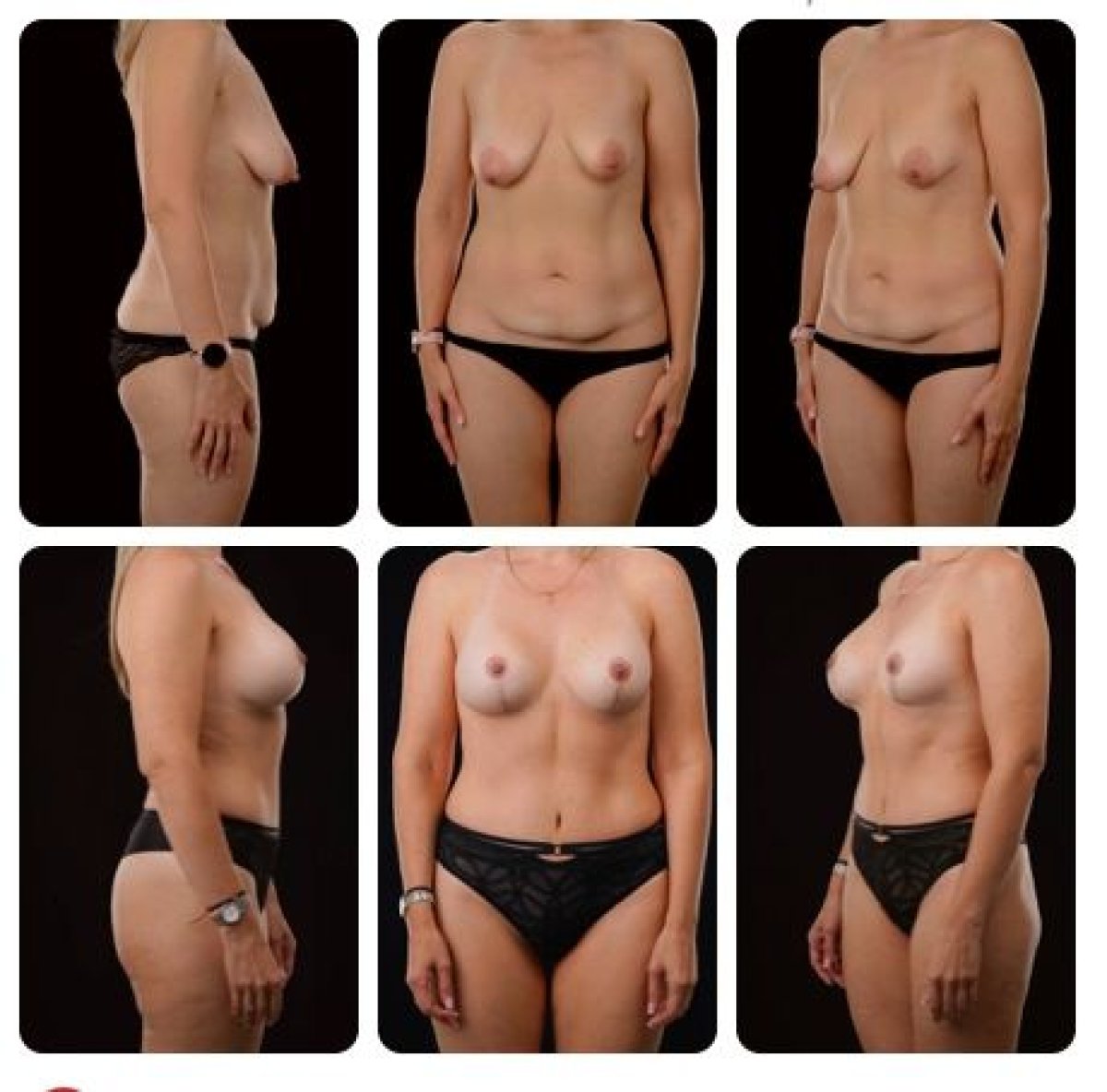 Результаты до и после абдоминопластики в Yurchenko Plastic Surgery Team, улучшенный контур живота