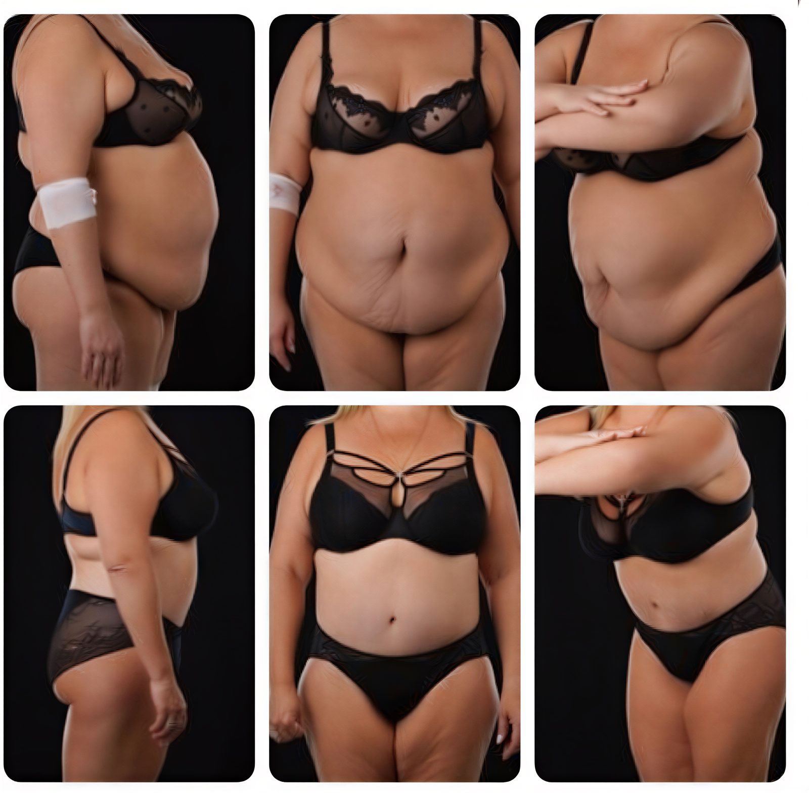 نتائج شد البطن قبل وبعد في Yurchenko Plastic Surgery Team، تحسين واضح لشكل الجسم