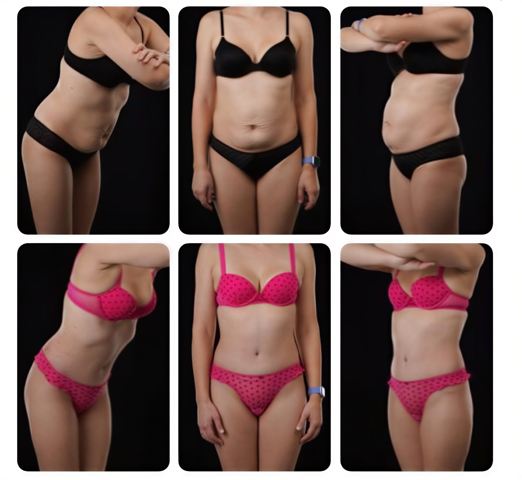 Resultados de abdominoplastia antes y después en Yurchenko Plastic Surgery Team, abdomen plano