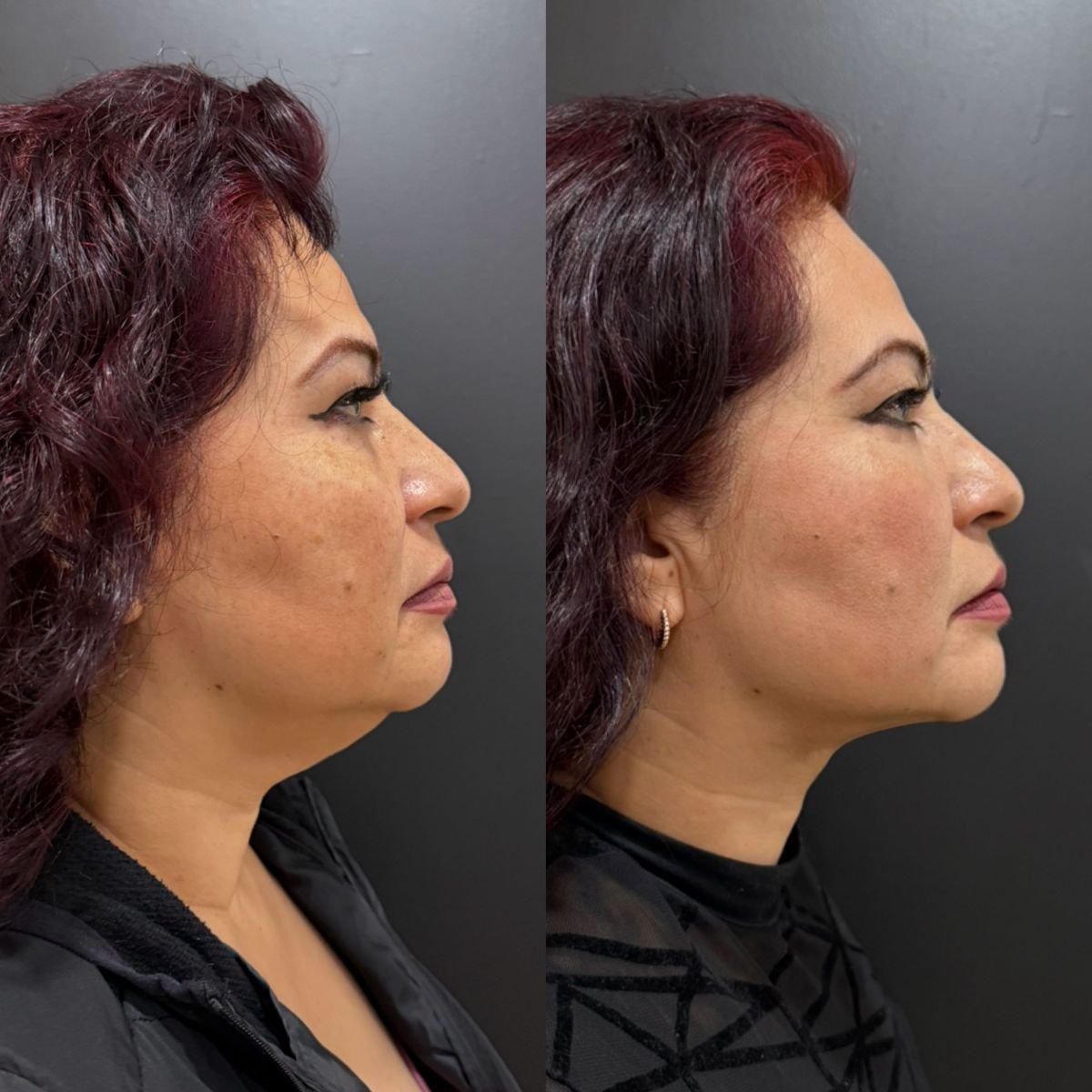 Before and after neck lift results – improved jawline and neck contour after procedure