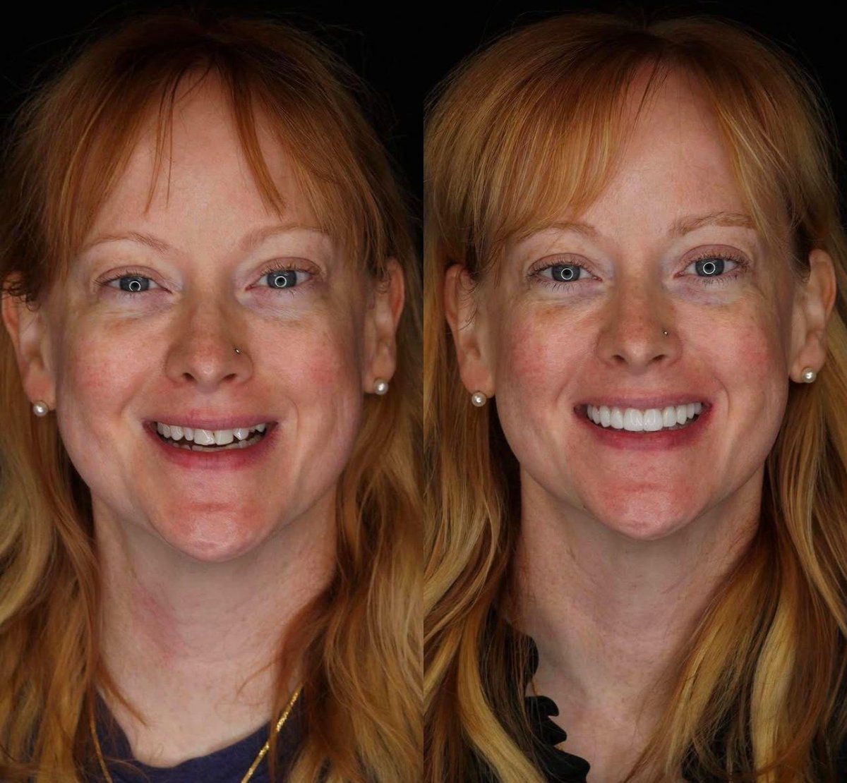 Antes y después de Hollywood Smile en Estemarley – carillas dentales para sonrisa brillante