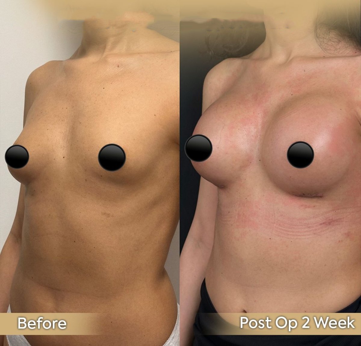 Avant/après augmentation mammaire par lipofilling à la clinique Dr. Safa Manav, résultat visible