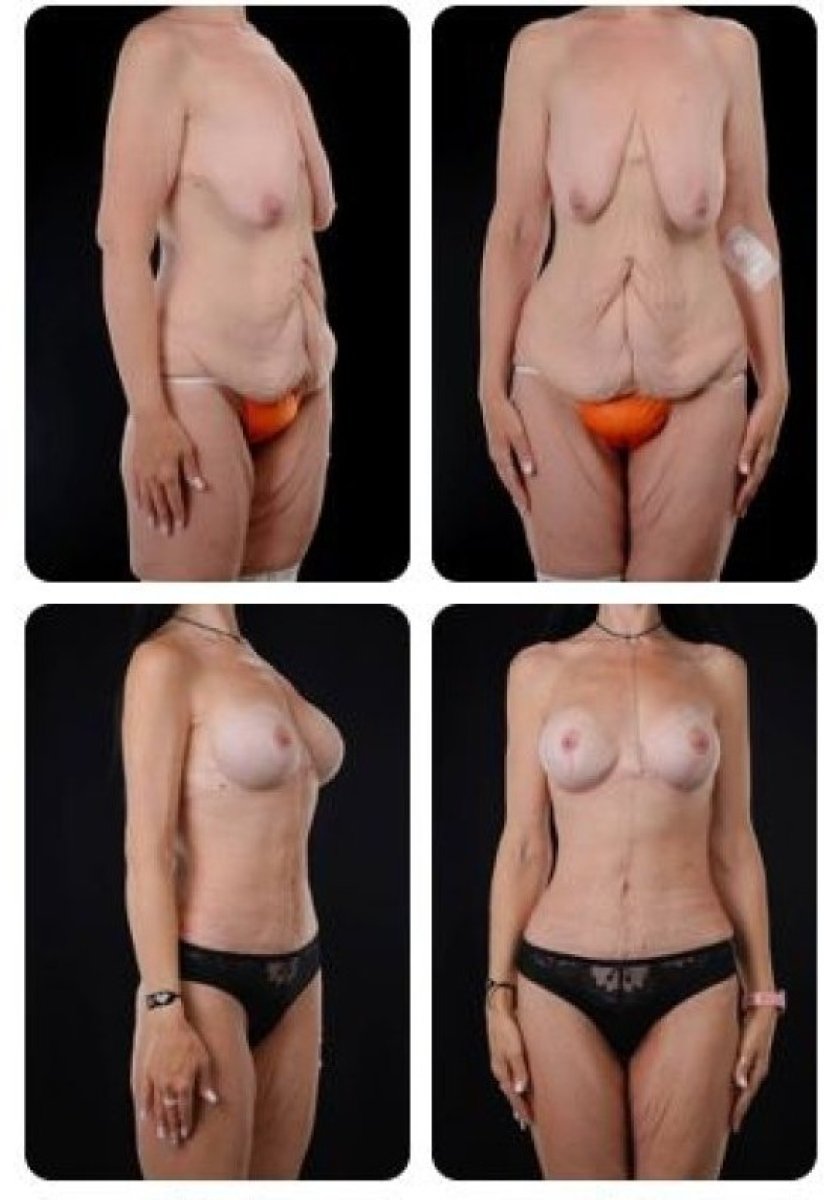 نتائج شد البطن ورفع الثدي قبل وبعد في عيادة Yurchenko Plastic Surgery Team