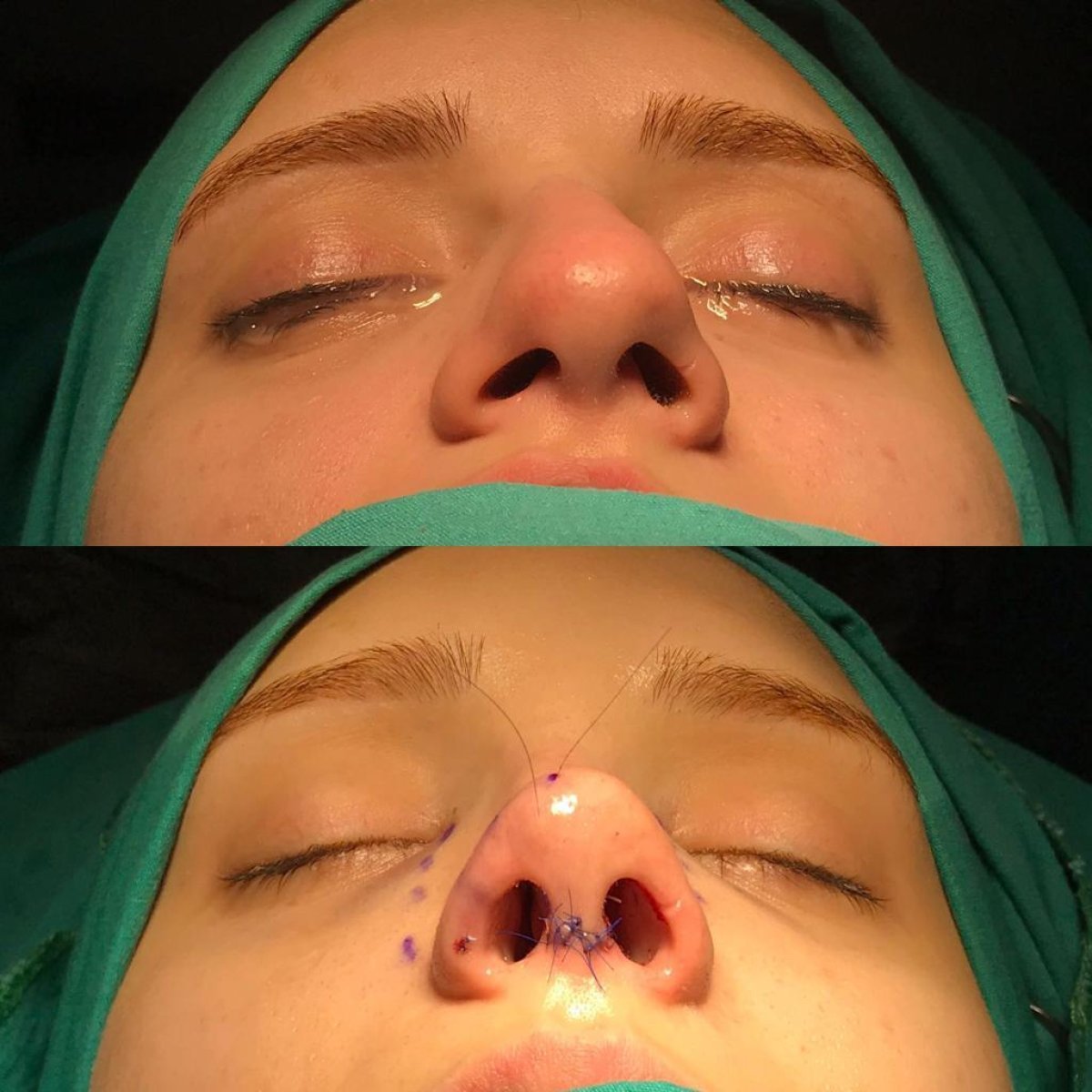 Resultados de rinoplastia antes y después en Estemarley, remodelación visible de la nariz