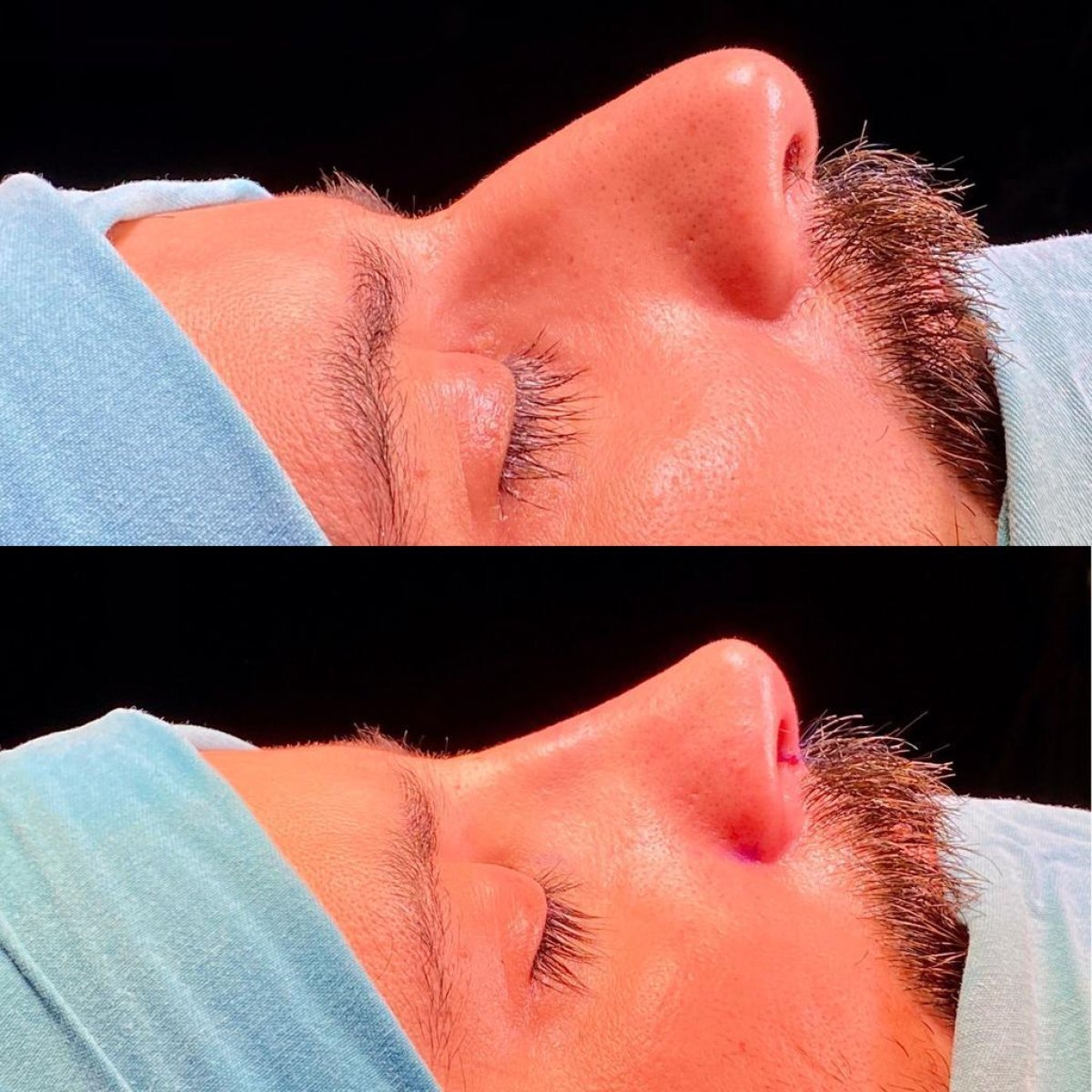 Resultados de rinoplastia antes y después en Estemarley, mejora de forma y perfil nasal