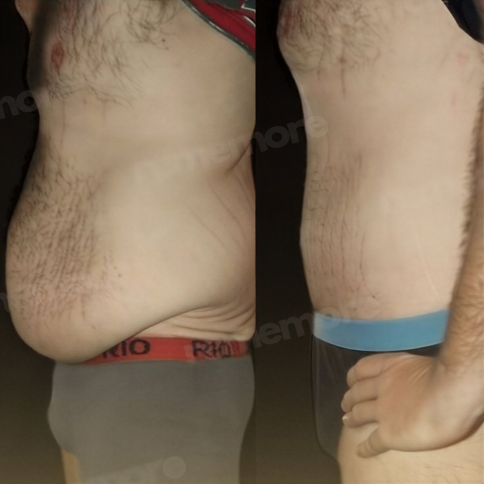 Resultados antes y después de Vaser liposucción en Memorial Göztepe Hospital, contorno abdominal