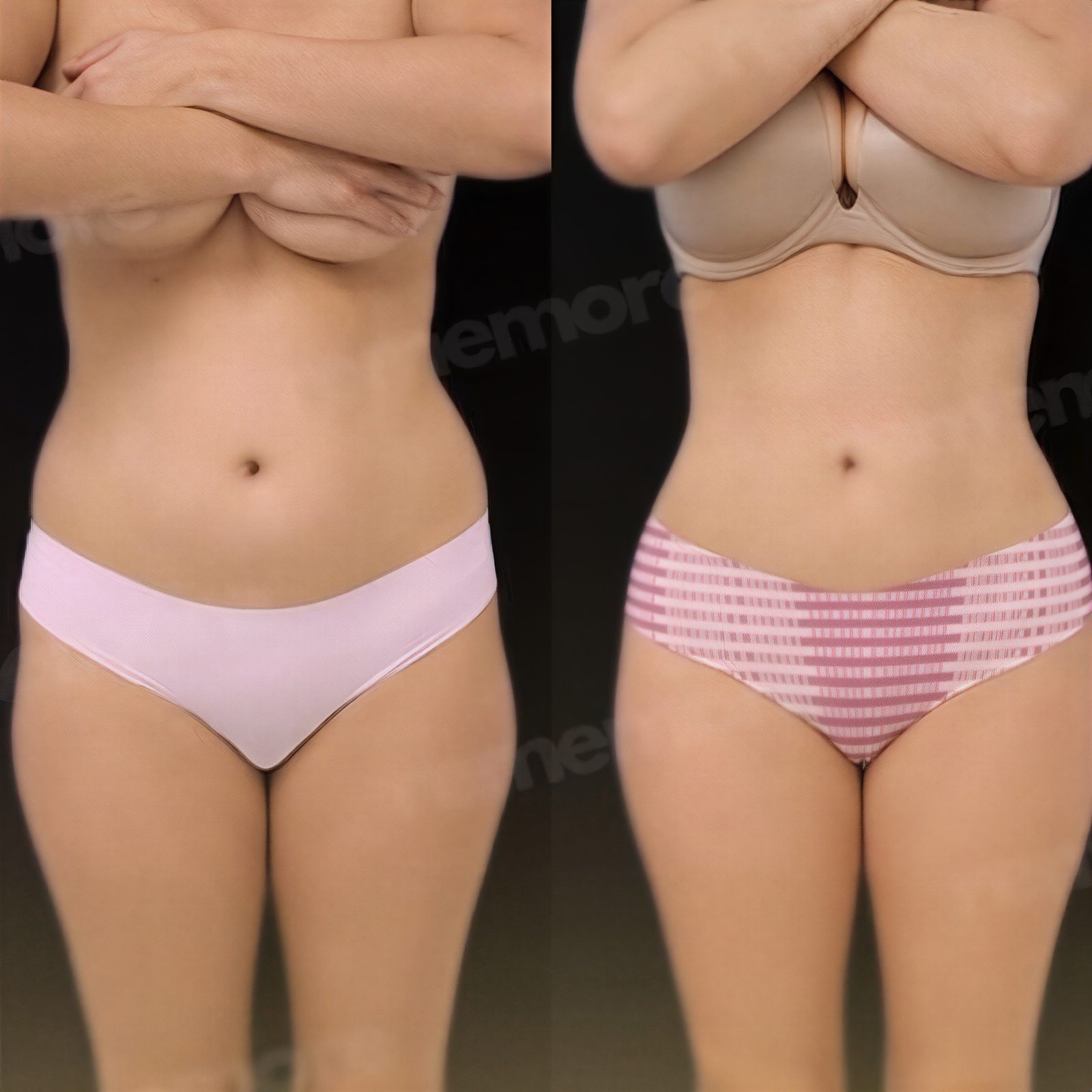 Resultados antes y después de liposucción Vaser en Memorial Göztepe Hospital, contorno corporal
