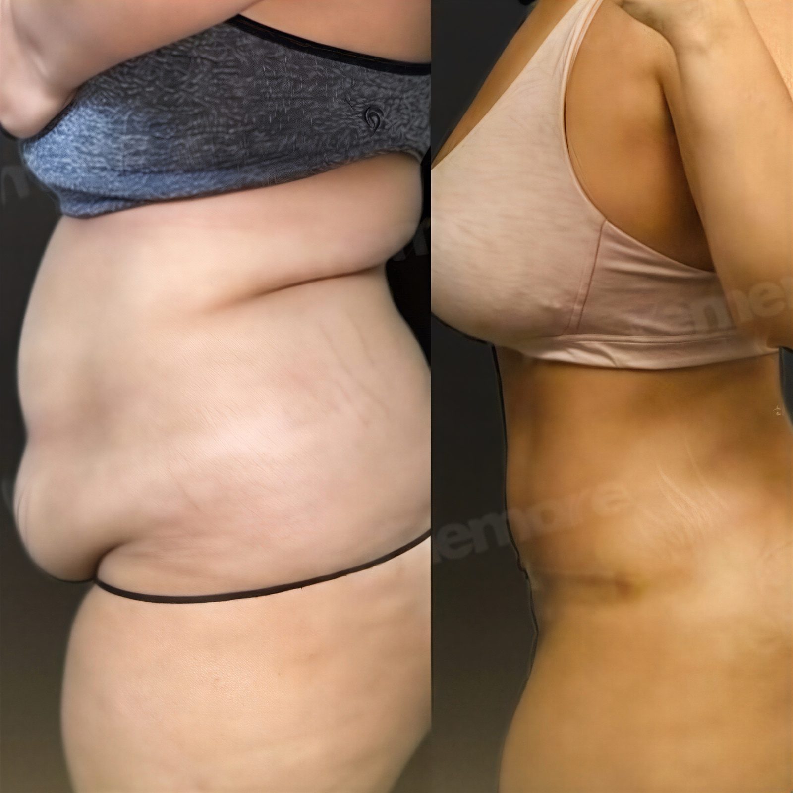 Resultados antes y después de liposucción Vaser abdominal en Memorial Göztepe Hospital