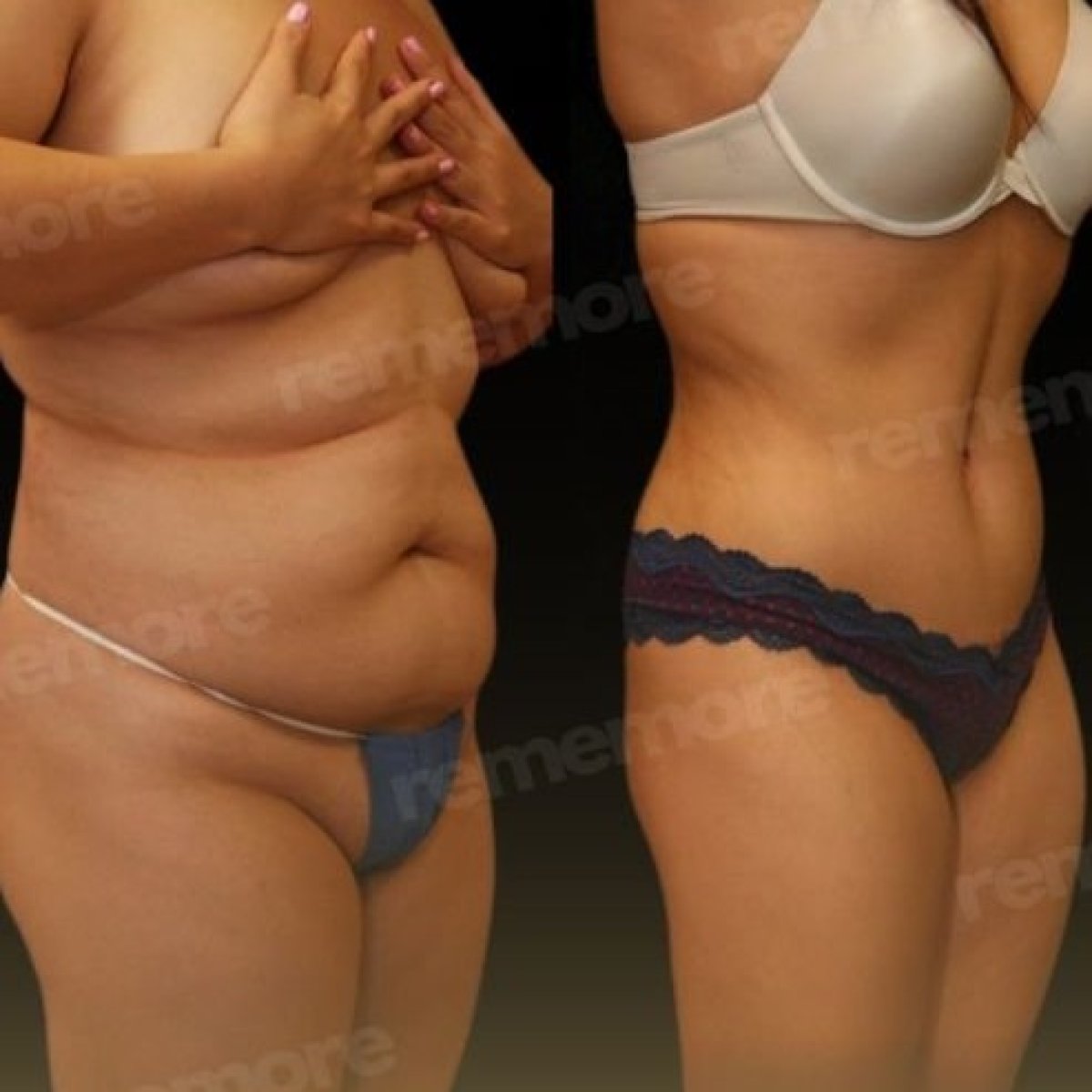 Before and after Vaser liposuction results at Memorial Göztepe Hospital, body contouring