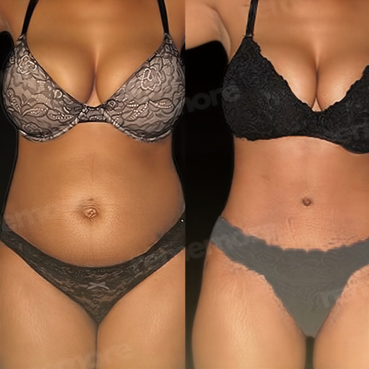 Resultados antes y después de liposucción Vaser en Memorial Göztepe Hospital, contorno corporal