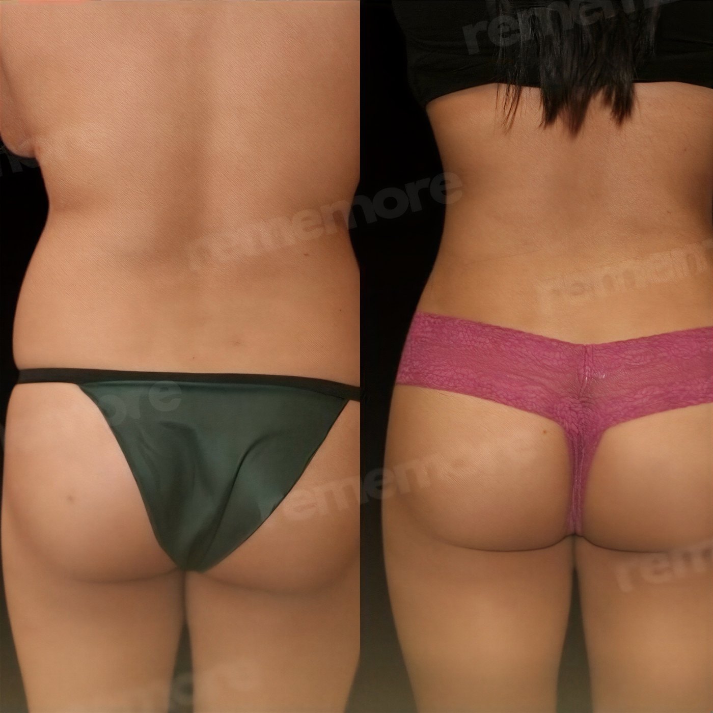 Resultados antes y después de Vaser liposucción en Memorial Göztepe Hospital, cintura mejorada