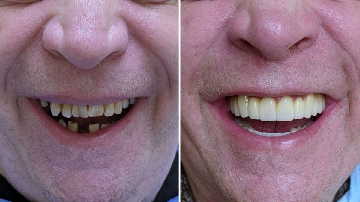 Результат до и после имплантации All-on-6 в Smile Centrum – восстановленная улыбка