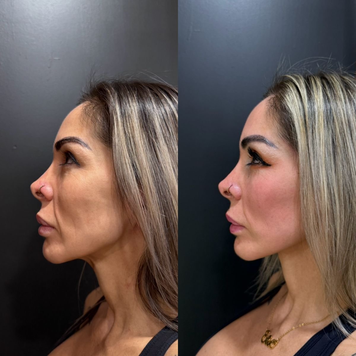 Mini facelift before and after results – visible facial rejuvenation and contour improvement