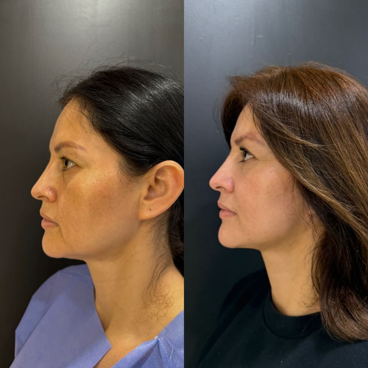 Résultats mini lifting avant et après – rajeunissement et amélioration du contour du visage