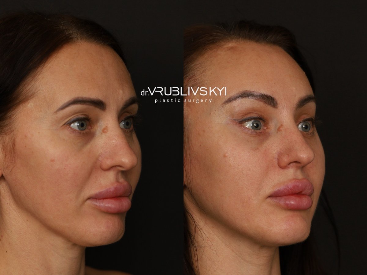Résultats lifting visage avant/après chez Dr. VRUBLIVSKYI Plastic Surgery, rajeunissement