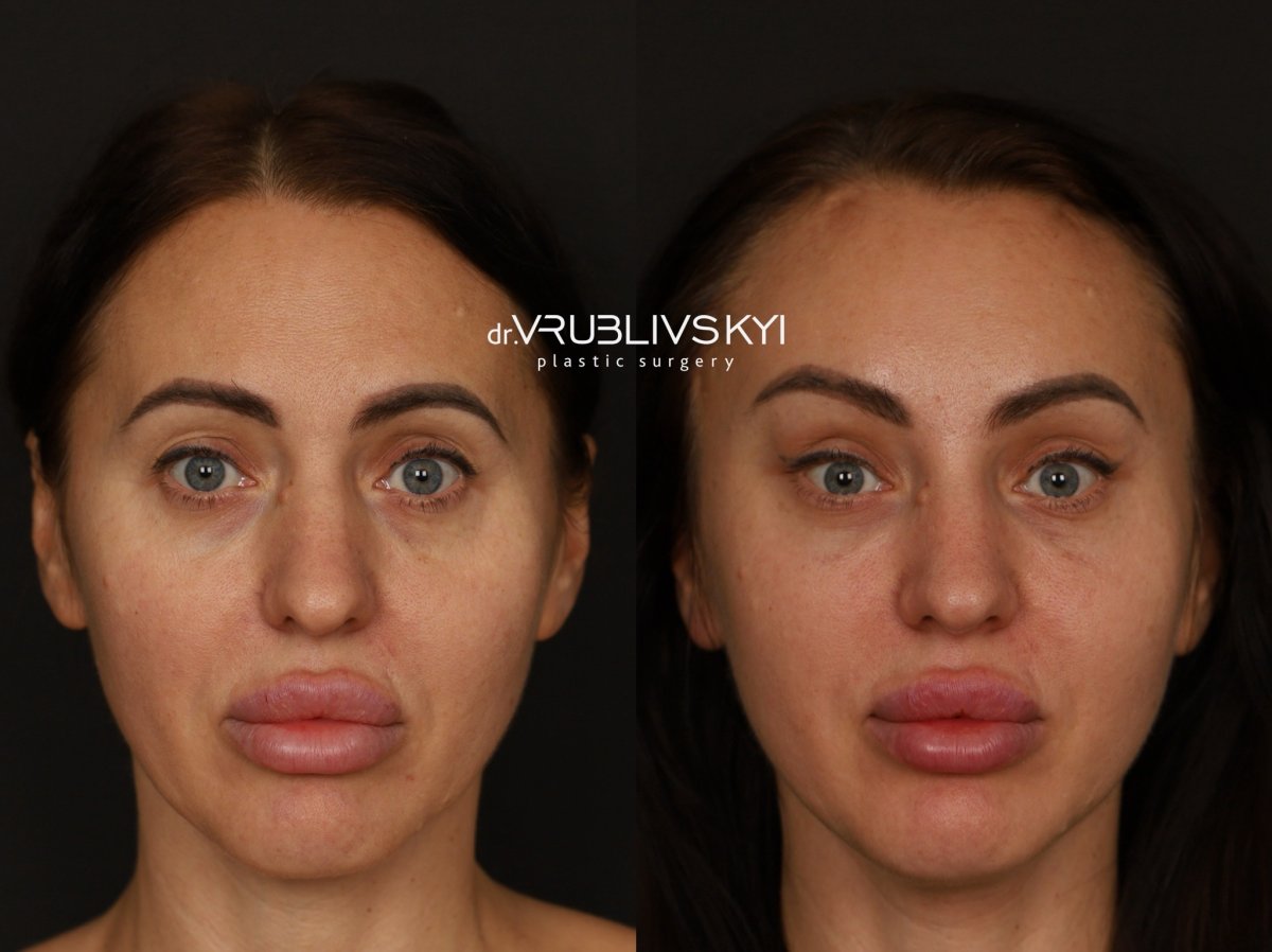 نتائج شد الوجه قبل وبعد في Dr. VRUBLIVSKYI Plastic Surgery، تجديد شباب الوجه
